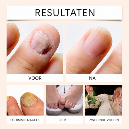 NailCure™ | Voor Gezonde, Schone En Perfect Verzorgde Nagels | 1+1 GRATIS
