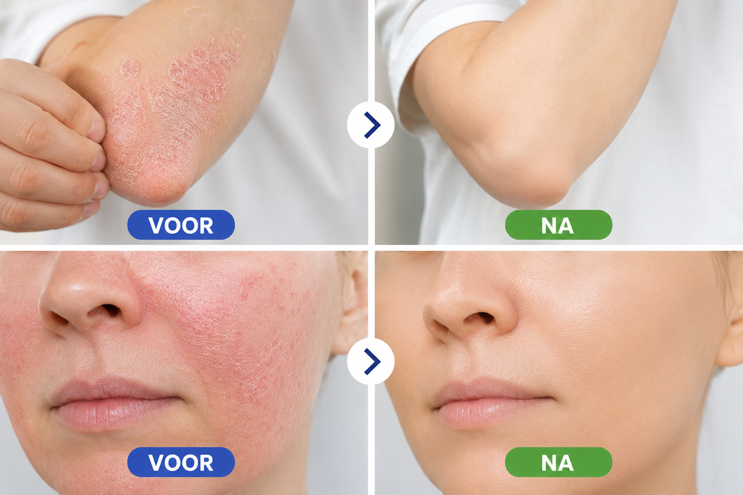 CalmSkin™ | Intensieve herstelbalsem bij droogheid, roodheid en schilfers