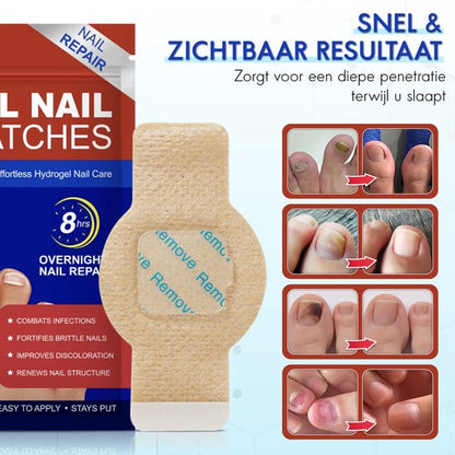 CuraNail™ | Herstelt Uw Nagels Terwijl U Slaapt | 1+1 gratis (42 pleisters)