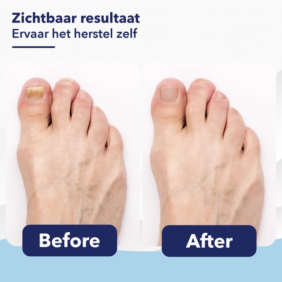 CuraNail™ | Herstelt Uw Nagels Terwijl U Slaapt | 1+1 gratis (42 pleisters)