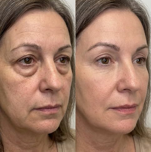 EyeLift™ | Laat wallen verdwijnen & strijk rimpeltjes glad in enkele minuten | 1+1 gratis