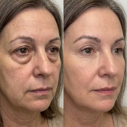 EyeLift™ | Laat wallen verdwijnen & strijk rimpeltjes glad in enkele minuten | 1+1 gratis