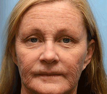 Anti-Wrinkle™ | Botox Rimpelverwijdering Crème | 1+1 gratis