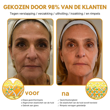 Anti-Wrinkle™ | Botox Rimpelverwijdering Crème | 1+1 gratis
